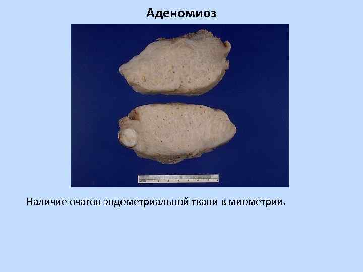 Аденомиоз Наличие очагов эндометриальной ткани в миометрии. 