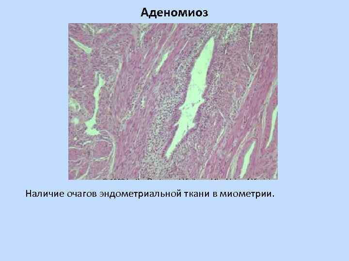 Аденомиоз Наличие очагов эндометриальной ткани в миометрии. 