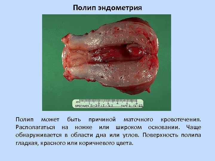 Полип эндометрия Полип может быть причиной маточного кровотечения. Располагаться на ножке или широком основании.