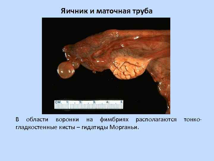 Яичник и маточная труба В области воронки на фимбриях располагаются гладкостенные кисты – гидатиды