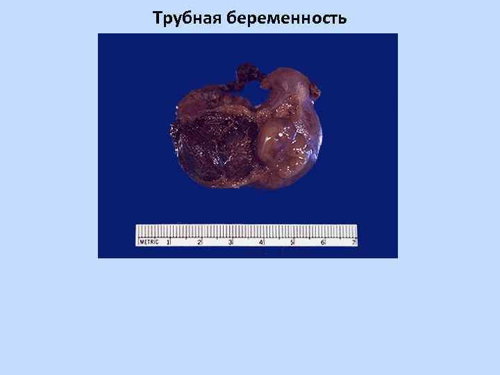 Трубная беременность 