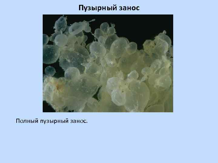 Пузырный занос Полный пузырный занос. 