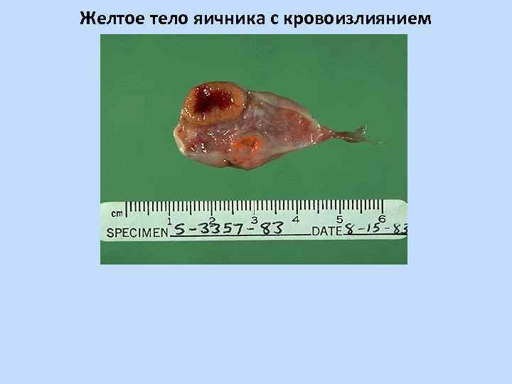 Желтое тело яичника с кровоизлиянием 