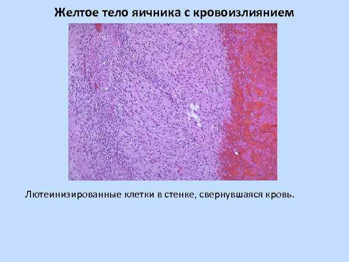 Желтое тело яичника с кровоизлиянием Лютеинизированные клетки в стенке, свернувшаяся кровь. 