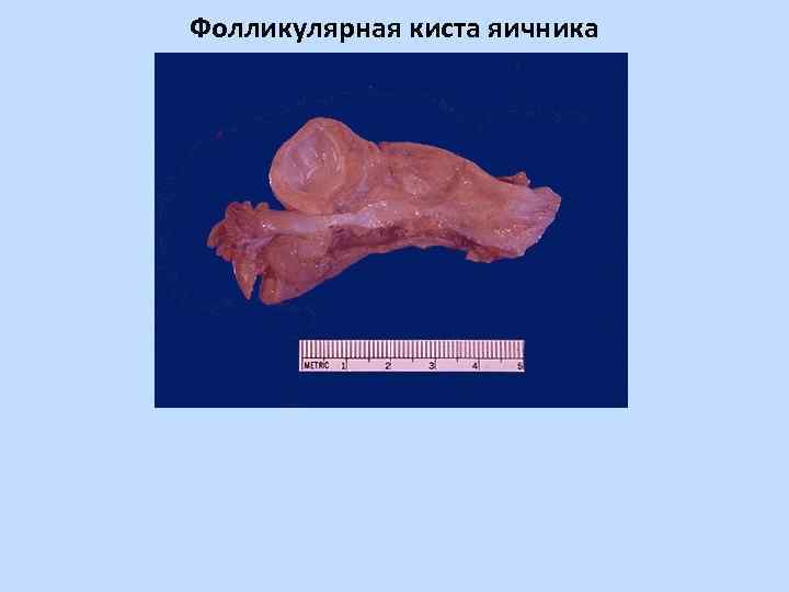 Фолликулярная киста яичника 