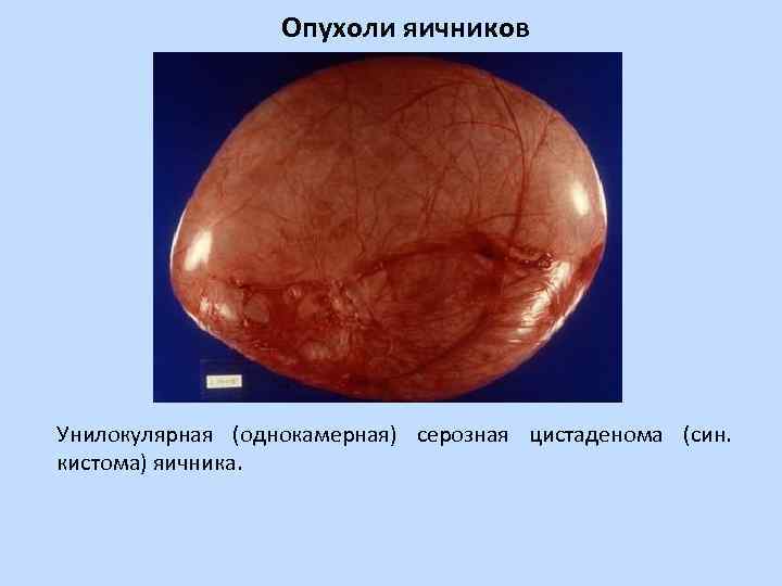 Опухоли яичников Унилокулярная (однокамерная) серозная цистаденома (син. кистома) яичника. 