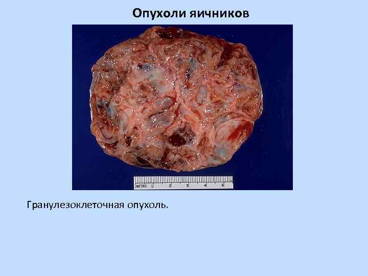 Опухоли яичников Гранулезоклеточная опухоль. 