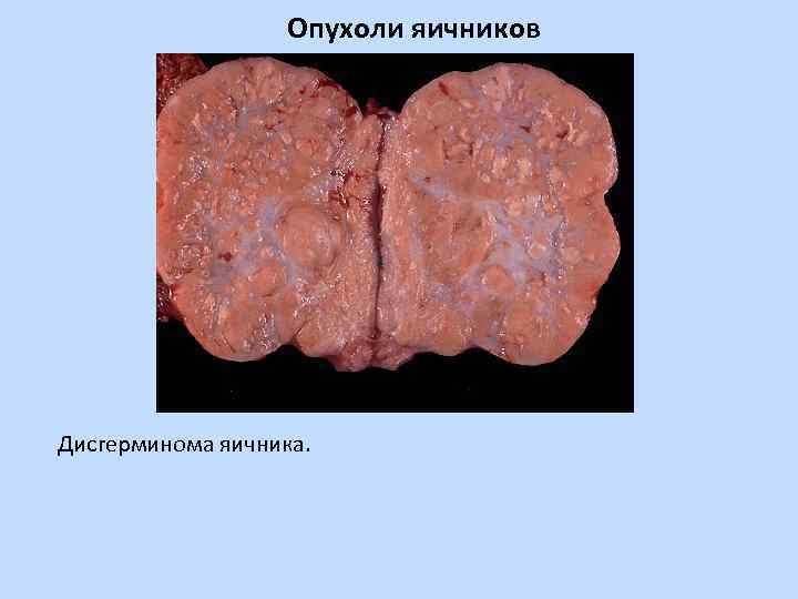 Опухоли яичников Дисгерминома яичника. 