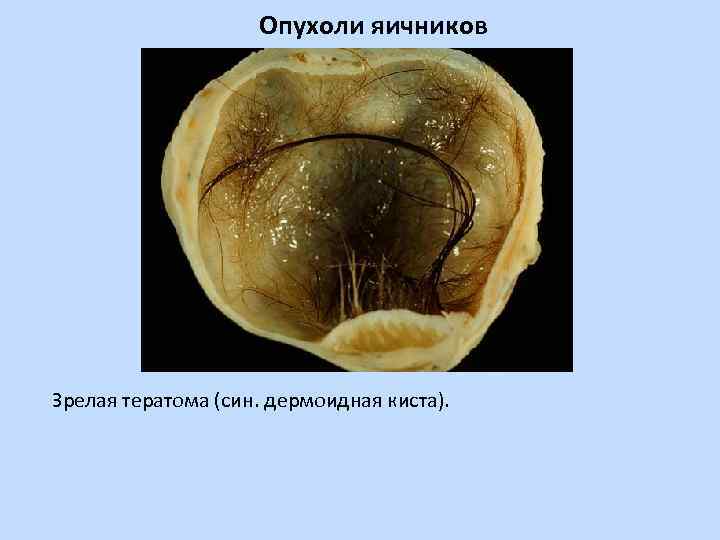 Опухоли яичников Зрелая тератома (син. дермоидная киста). 