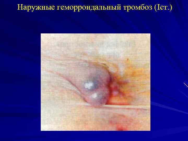 Наружные геморроидальный тромбоз (Iст. ) 