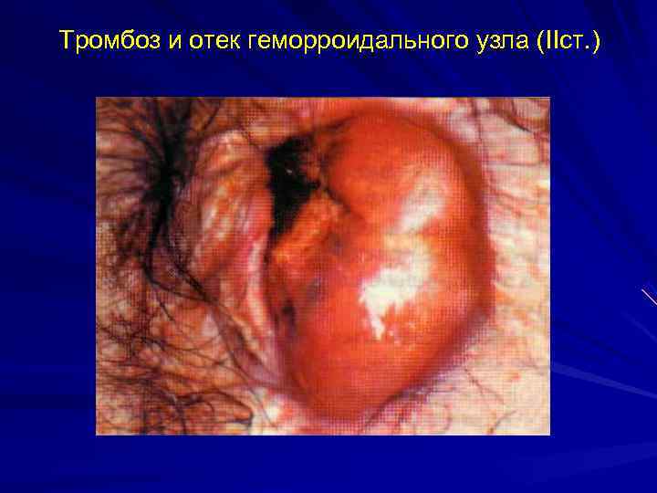 Тромбоз и отек геморроидального узла (IIст. ) 