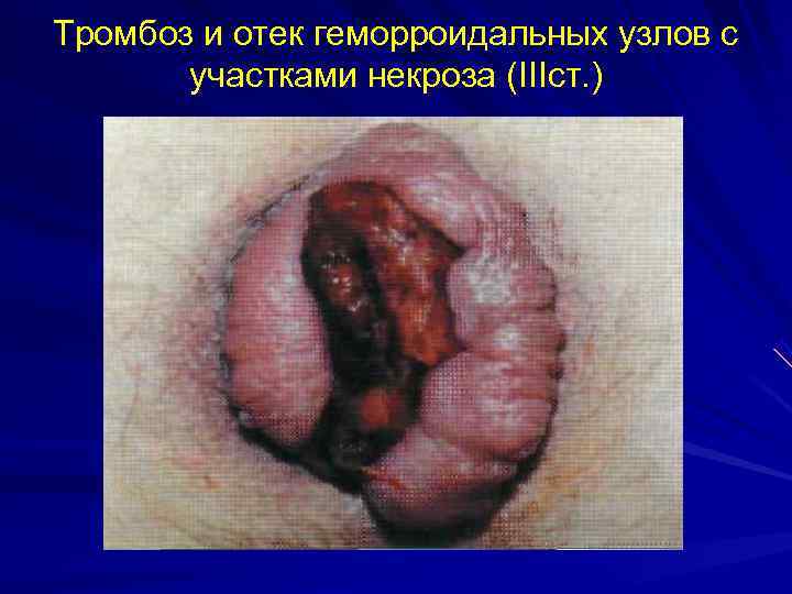 Тромбоз и отек геморроидальных узлов с  участками некроза (IIIст. ) 