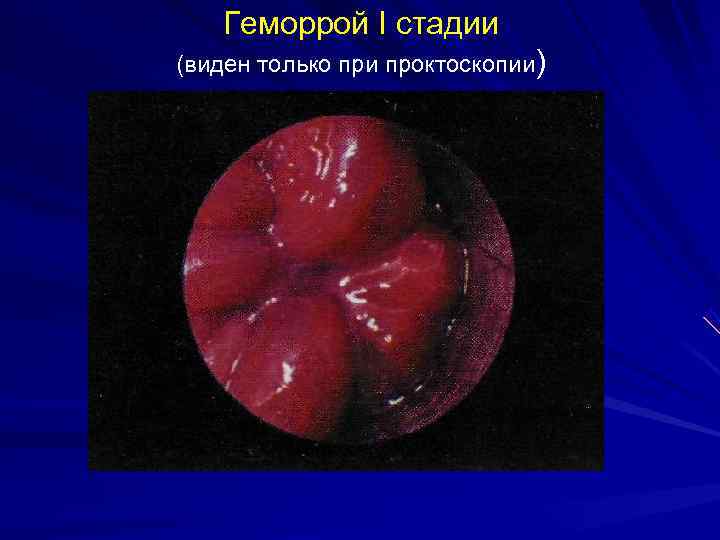   Геморрой I стадии (виден только при проктоскопии) 