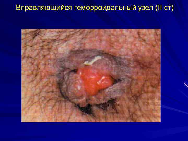 Вправляющийся геморроидальный узел (II ст) 