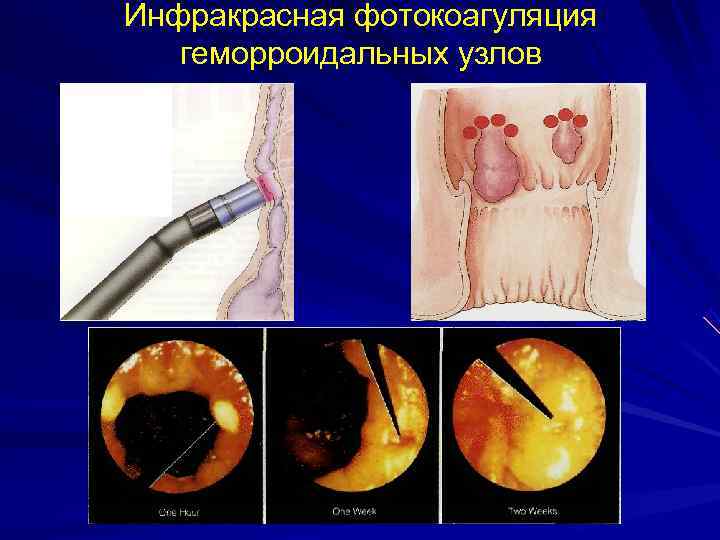 Инфракрасная фотокоагуляция  геморроидальных узлов 