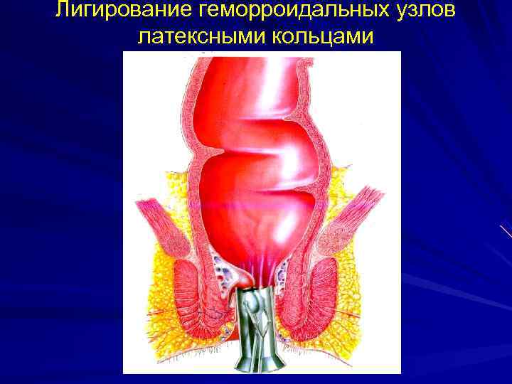 Лигирование геморроидальных узлов  латексными кольцами 