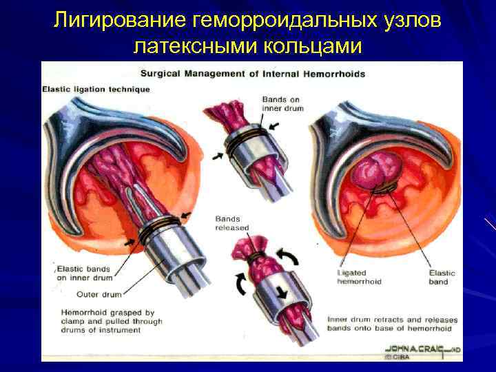 Лигирование геморроидальных узлов  латексными кольцами 