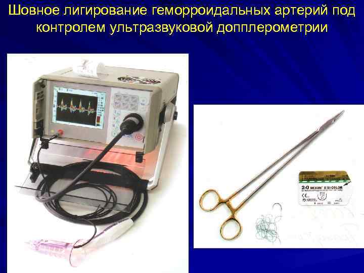 Шовное лигирование геморроидальных артерий под  контролем ультразвуковой допплерометрии 