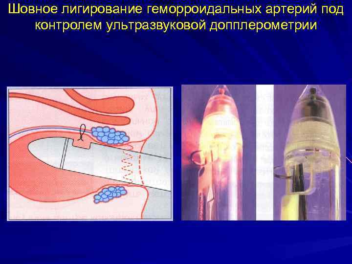 Шовное лигирование геморроидальных артерий под  контролем ультразвуковой допплерометрии 