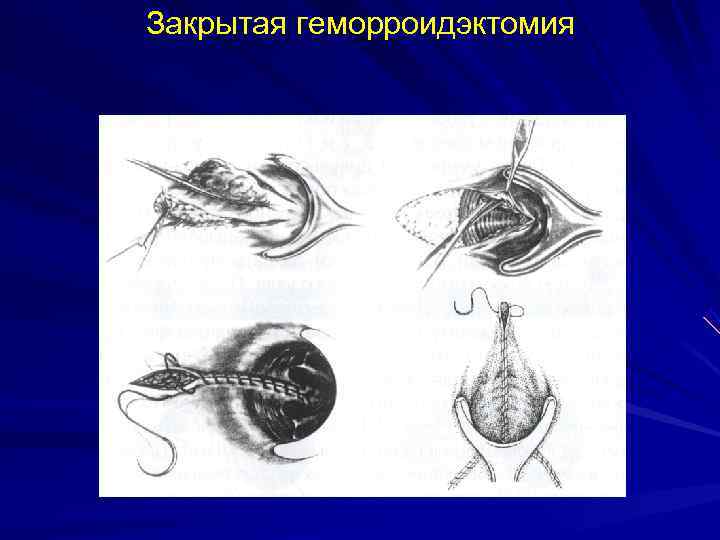 Закрытая геморроидэктомия 