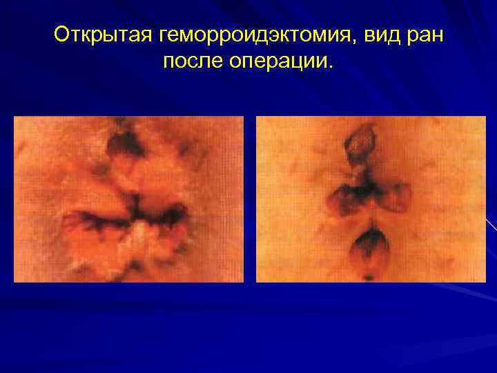 Открытая геморроидэктомия, вид ран  после операции. 