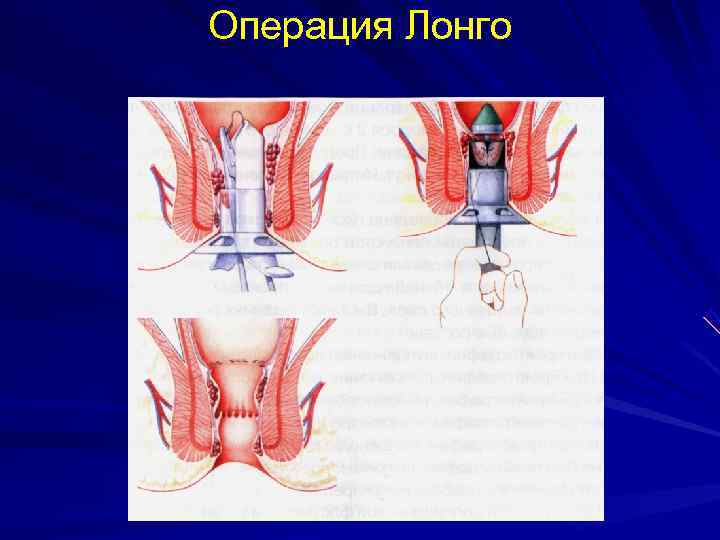 Операция Лонго 