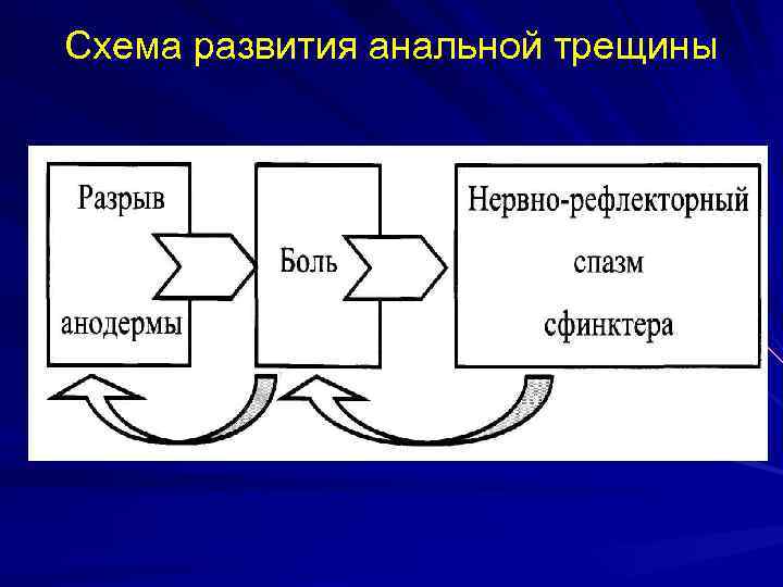 Схема развития анальной трещины 