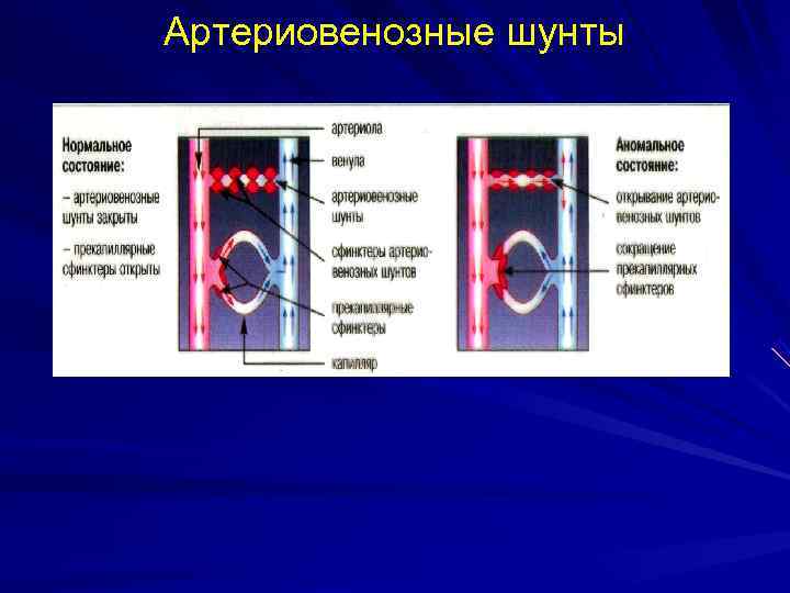 Артериовенозные шунты 