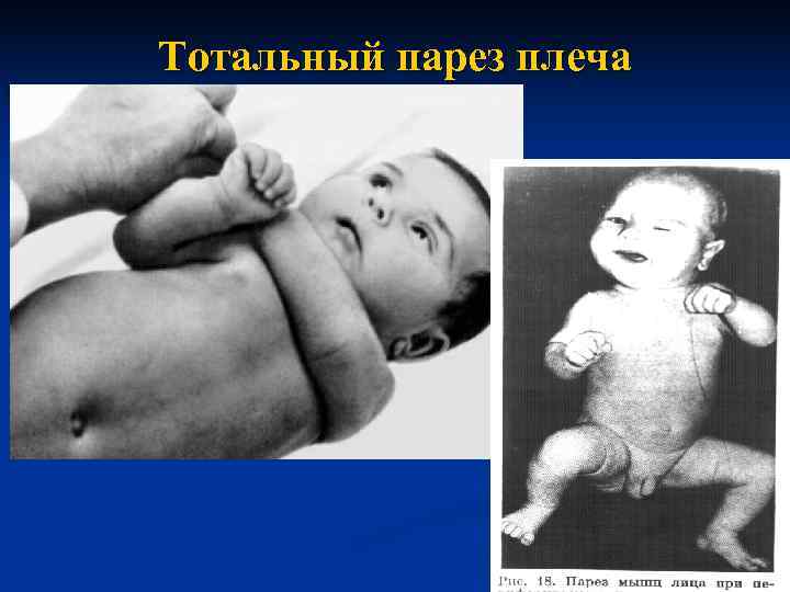 Тотальный парез плеча 