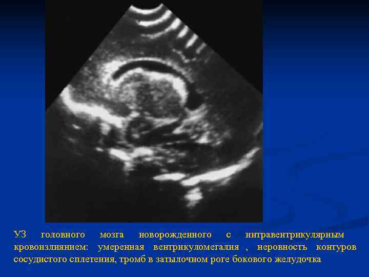 УЗ головного мозга новорожденного с интравентрикулярным кровоизлиянием: умеренная вентрикуломегалия , неровность контуров сосудистого сплетения,