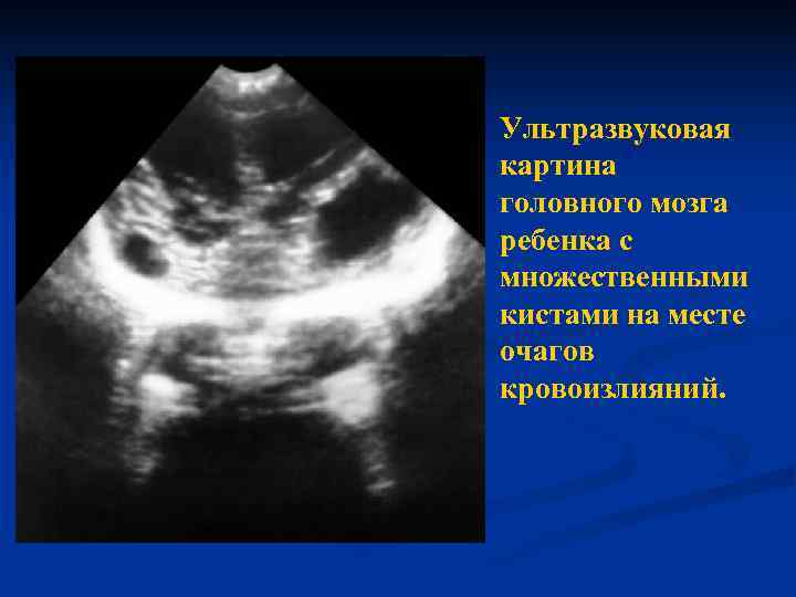 Ультразвуковая картина головного мозга ребенка с множественными кистами на месте очагов кровоизлияний. 