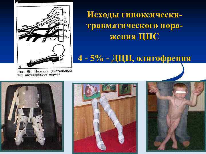  Исходы гипоксически- травматического пора-  жения ЦНС 4 - 5% - ДЦП, олигофрения