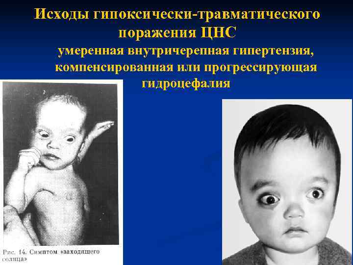 Исходы гипоксически-травматического  поражения ЦНС  умеренная внутричерепная гипертензия,  компенсированная или прогрессирующая 