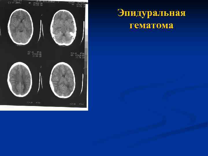Эпидуральная  гематома 