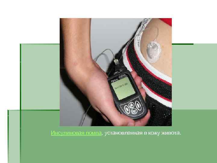 Инсулиновая помпа, установленная в кожу живота.  