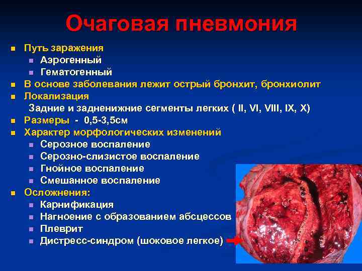 Очаговая пневмония n n n Путь заражения n Аэрогенный n Гематогенный В основе заболевания