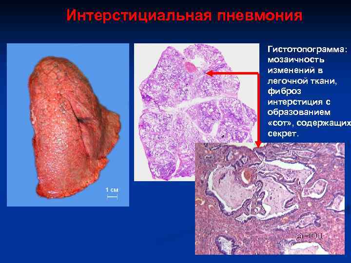 Интерстициальная пневмония Гистотопограмма: мозаичность изменений в легочной ткани, фиброз интерстиция с образованием «сот» ,