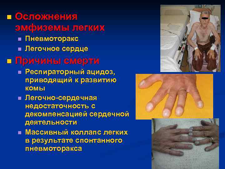 n Осложнения эмфиземы легких n n n Пневмоторакс Легочное сердце Причины смерти n n