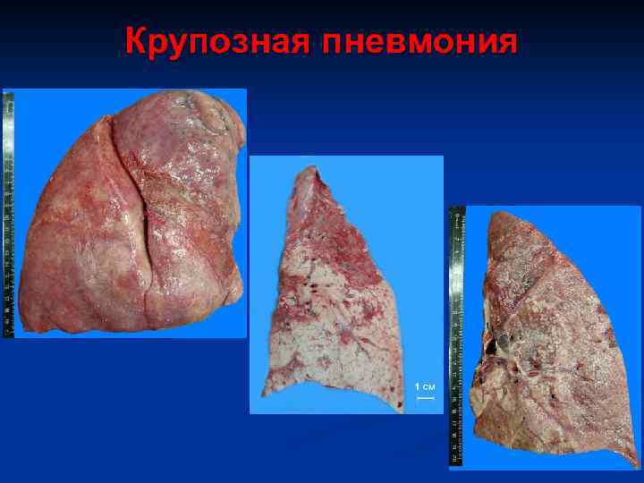 Крупозная пневмония 