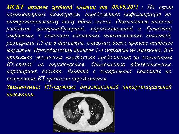 На компьютерной томограмме органов грудной клетки трахея определяется как