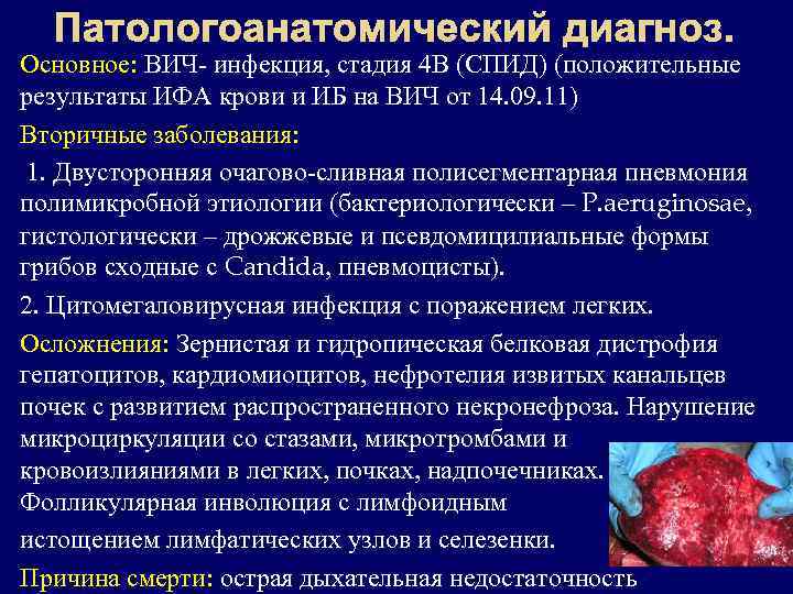  Патологоанатомический диагноз. Основное: ВИЧ- инфекция, стадия 4 В (СПИД) (положительные результаты ИФА крови