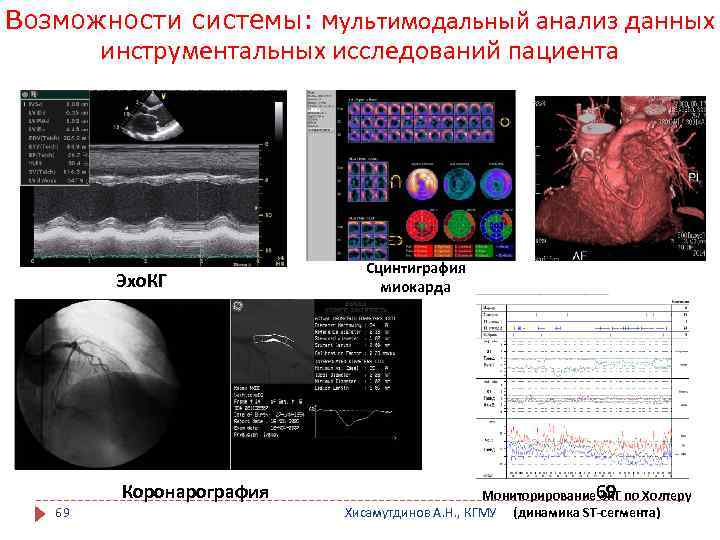 Возможности системы: мультимодальный анализ данных инструментальных исследований пациента Эхо. КГ Коронарография 69 Сцинтиграфия миокарда