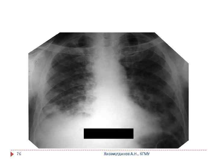 76 Хисамутдинов А. Н. , КГМУ 