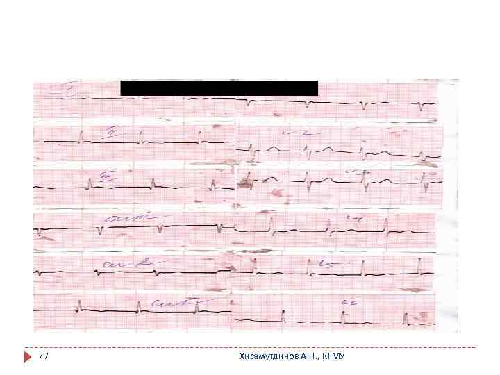 77 Хисамутдинов А. Н. , КГМУ 