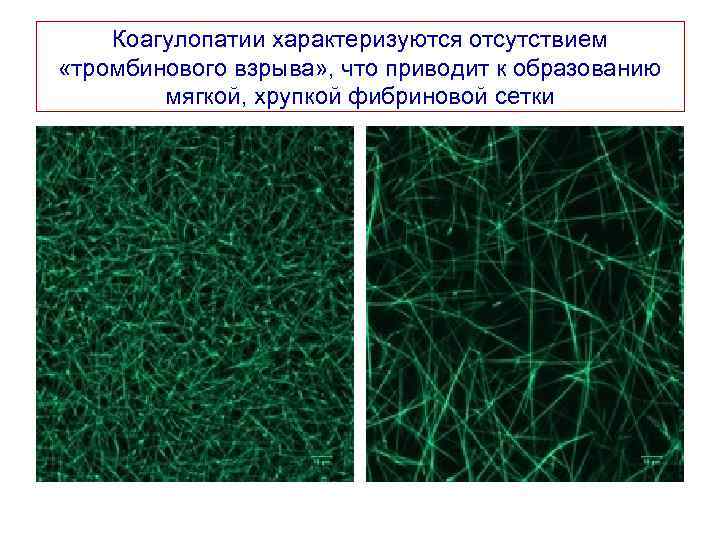 Коагулопатии характеризуются отсутствием «тромбинового взрыва» , что приводит к образованию мягкой, хрупкой фибриновой сетки
