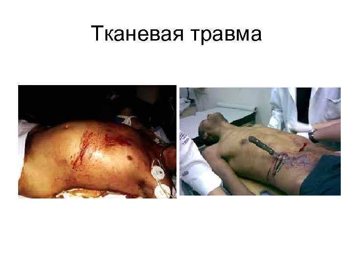 Тканевая травма 