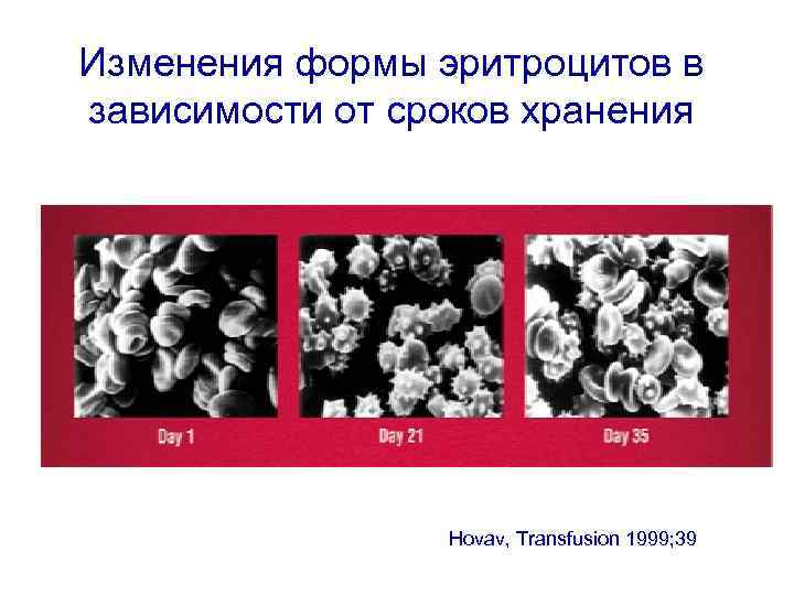 Изменения формы эритроцитов в зависимости от сроков хранения Hovav, Transfusion 1999; 39 
