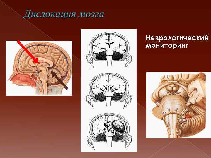 Дислокация мозга Неврологический мониторинг 