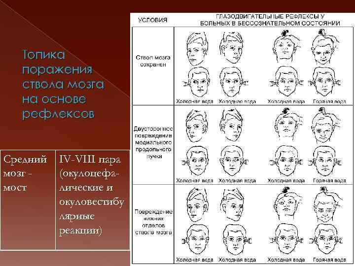Топика поражения ствола мозга на основе рефлексов Средний IV-VIII пара мозг (окулоцефамост лические и