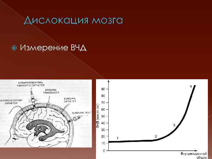 Дислокация мозга Измерение ВЧД 
